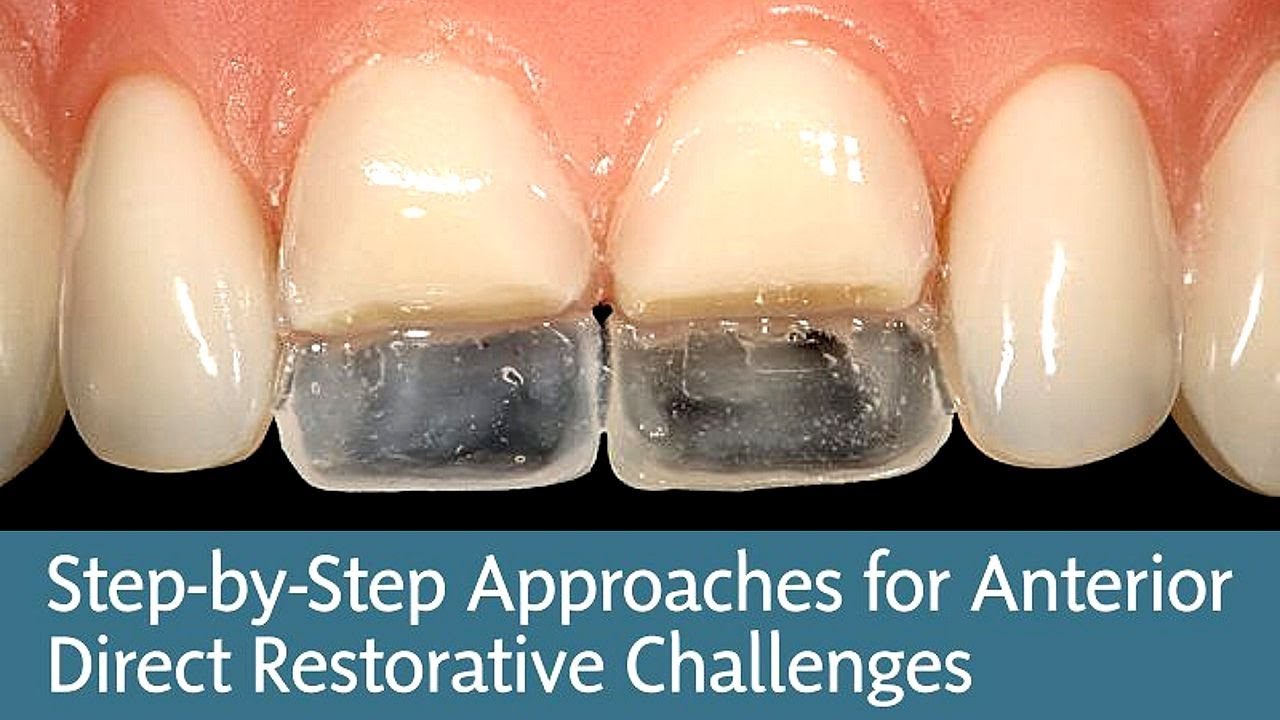 Step by Step Approaches for Anterior Direct Restorative Challenges - Newton Fahl, Jr., DDS