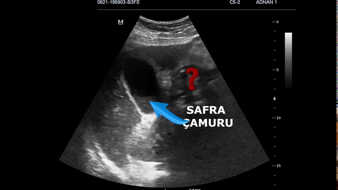 SAĞ ÜST KADRAN AĞRISINA ACİL ULTRASONOGRAFİK YAKLAŞIM; VAKA 1
