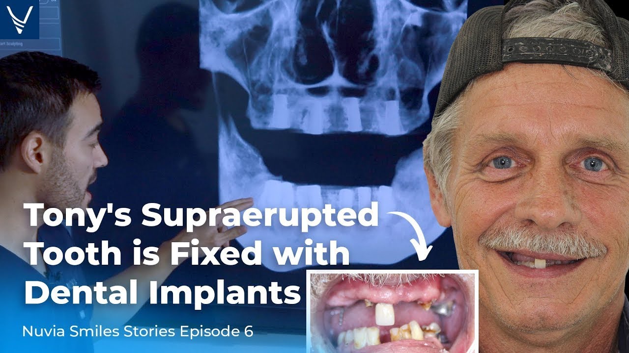 Tony's Supraerupted Tooth Fixed With Dental Implants