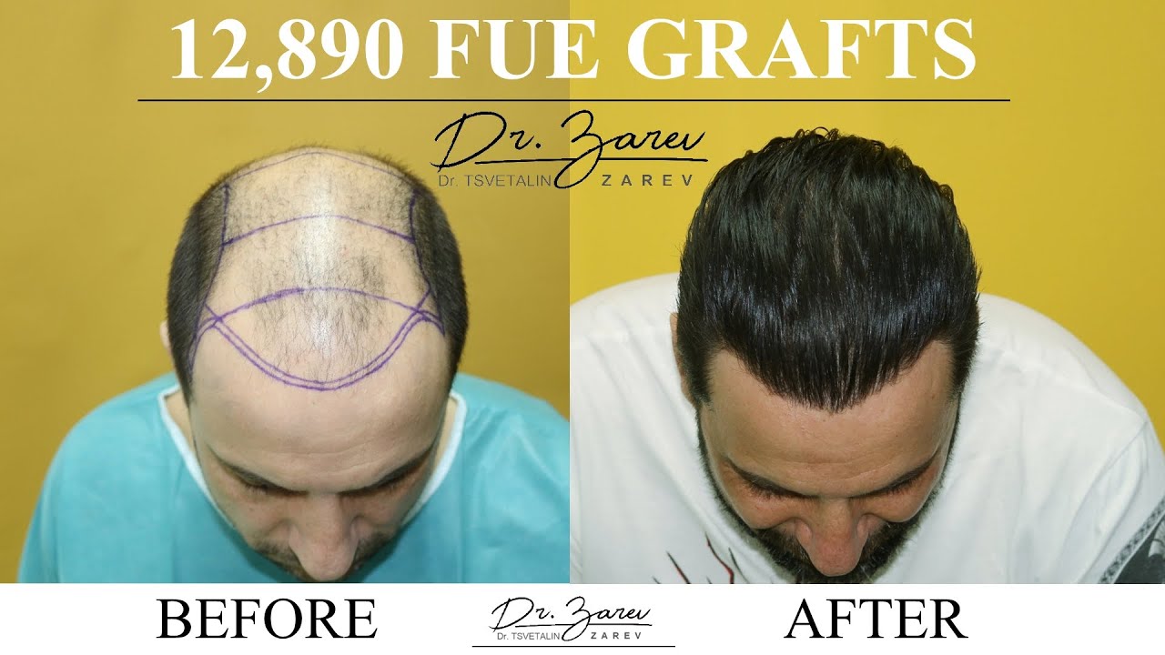 FUE Hair Transplant Result (12 890 Scalp Grafts)- Dr Zarev, Bulgaria