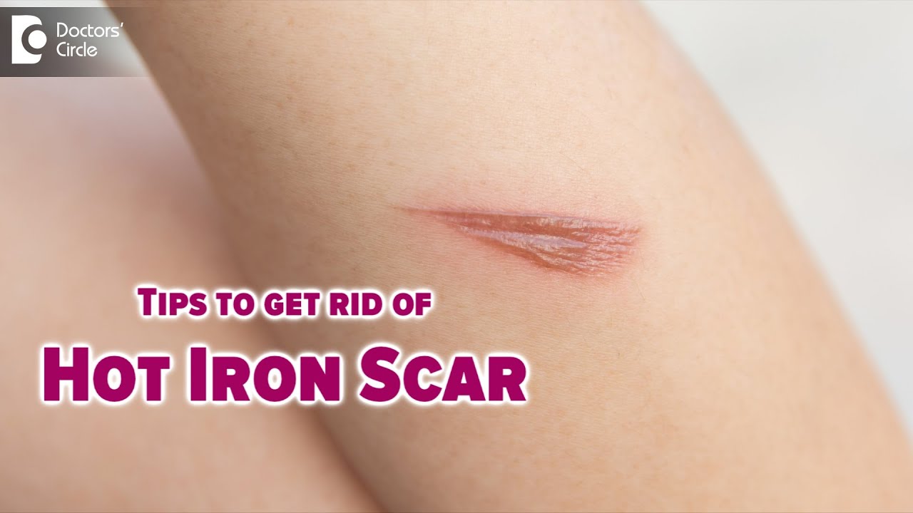 GET RID OF SCARS FROM BURNS | How do I remove a hot iron scar? - Dr. Nischal K | Doctors' Circle
