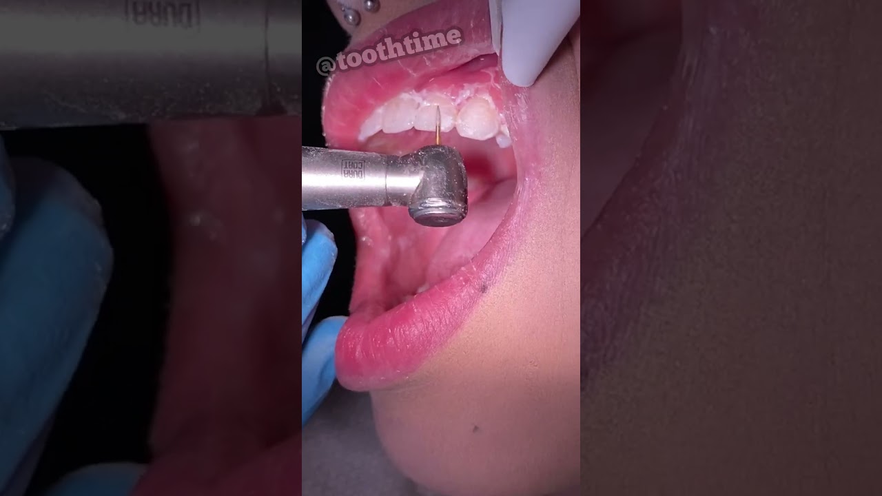 Braces Removal videos - PRO and CONS of wearing braces  -Tooth Time Family Dentistry New Braunfels