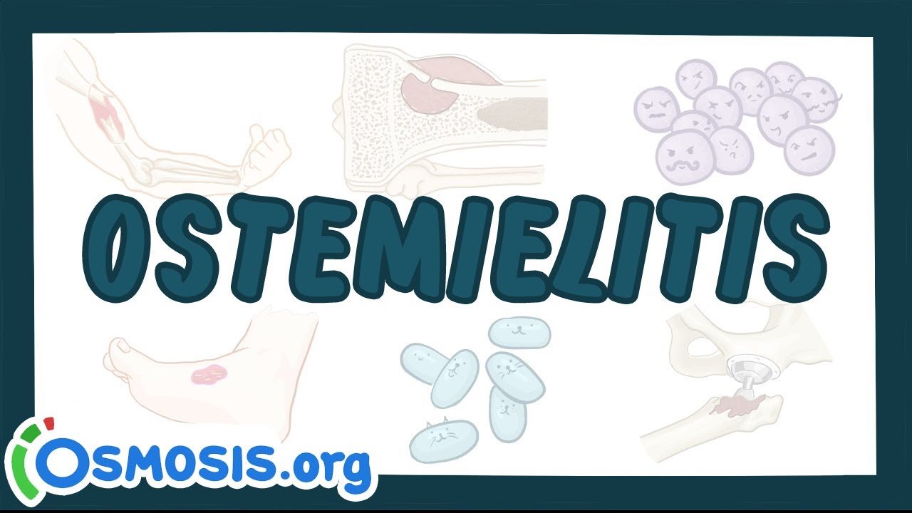 Osteomielitis - Ósmosis en Español