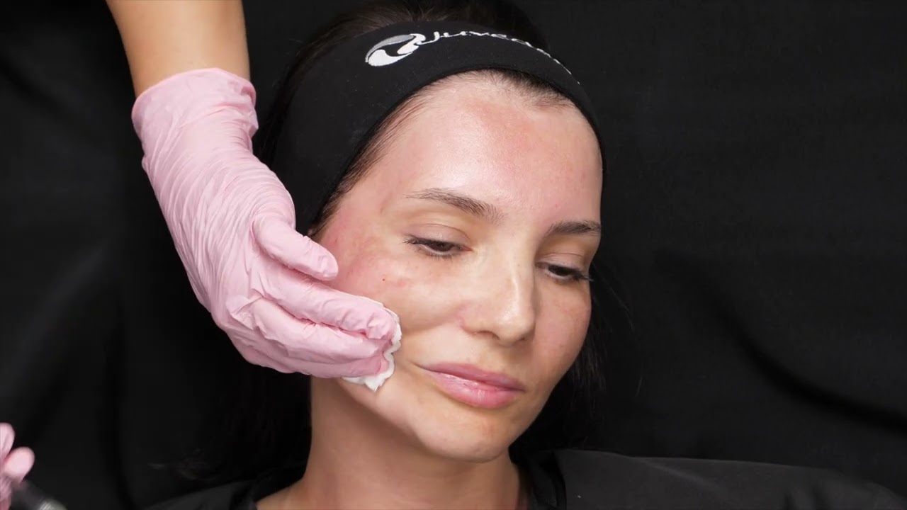 SKINVIVE™️ by Juvéderm®️ - Injection technique with Dr. Amalia Anghel