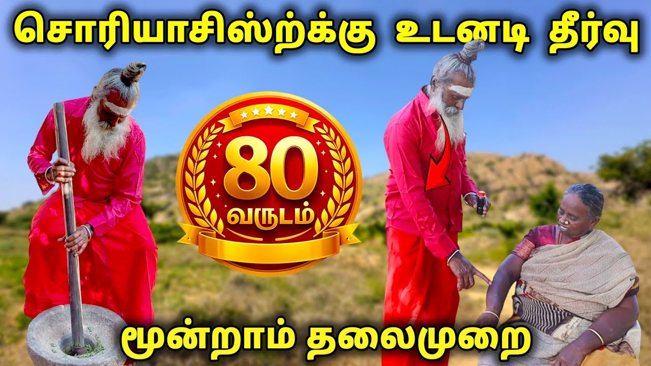 சொரியாசிஸ்ற்க்கு இனிமேல் தீர்வு💯 how to cure psoriasis psoriasis treatment siddha medicine psoriasis