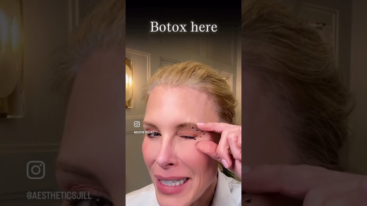 Botox can make your eyes appear larger #botox #beauty #filler