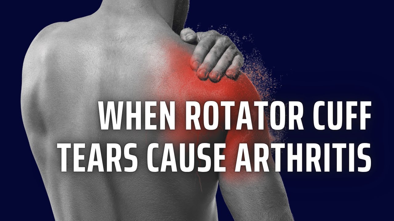 Rotator Cuff Arthropathy: When Rotator Cuff Tears Lead to Shoulder Arthritis