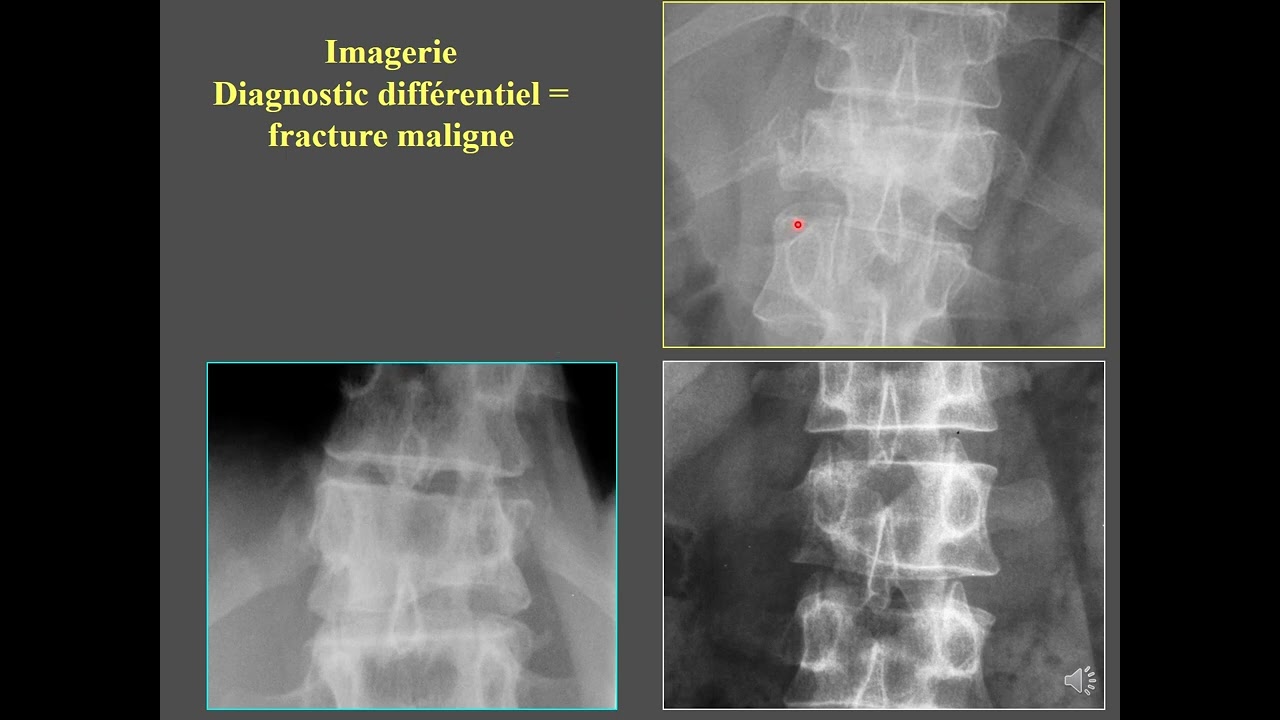 Ostéopathies fragilisantes - CERF