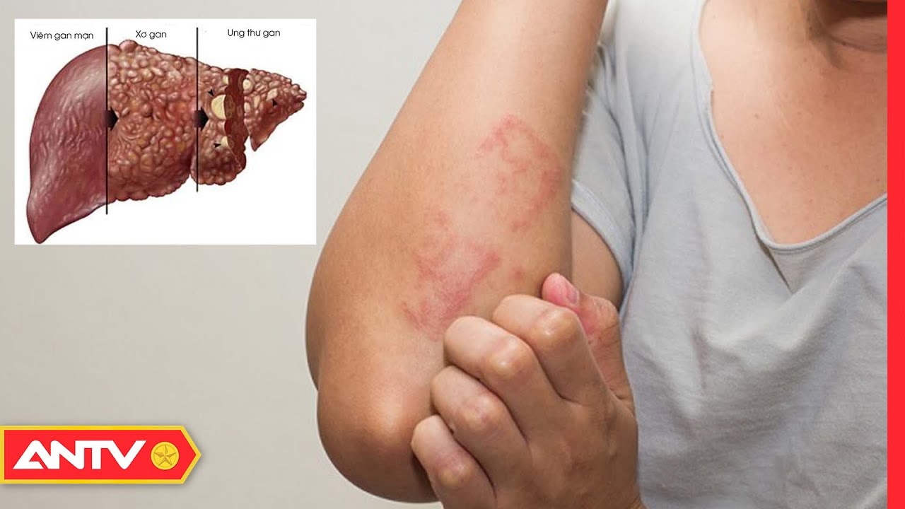 Nguy&ecirc;n Nh&acirc;n V&agrave; C&aacute;ch Điều Trị Vi&ecirc;m Gan B | Sức Khỏe 365 | ANTV