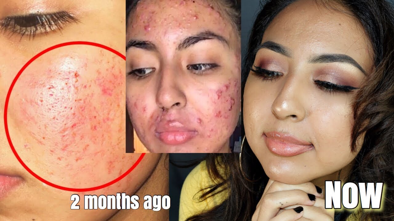 *one product to cure my acne* skincare routine (INEXPENSIVE & SIMPLE)