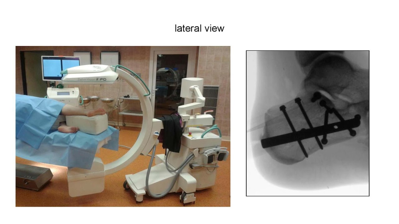 C-nail, X-ray positioning