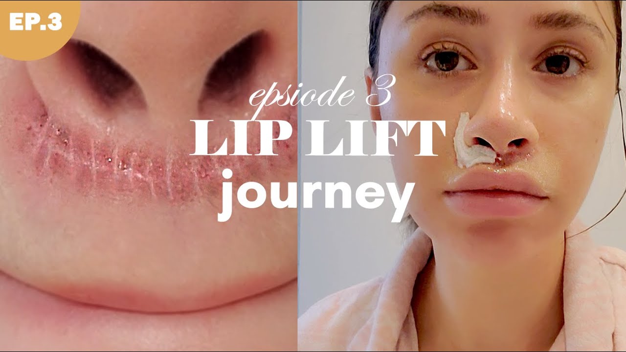 LIP LIFT SURGERY 💉 Episode 3 - This scar is not healing right...
