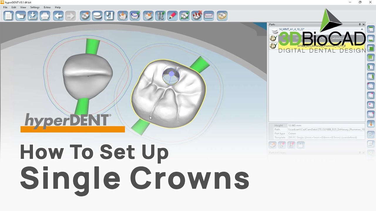 How To Set Up Single Crowns l FOLLOW-ME! hyperDENT l 3DBioCAD