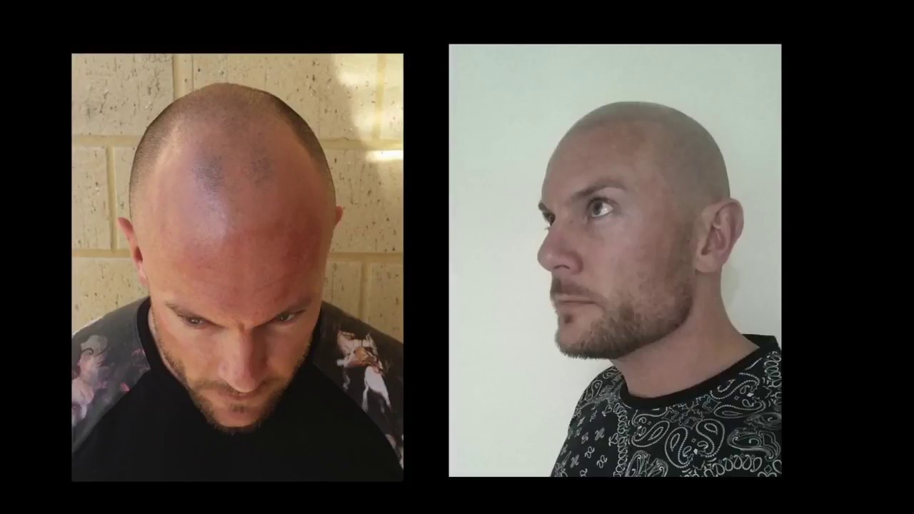 Hair Loss and Curing the look of Baldness In Men, Vinci Hair Clinic