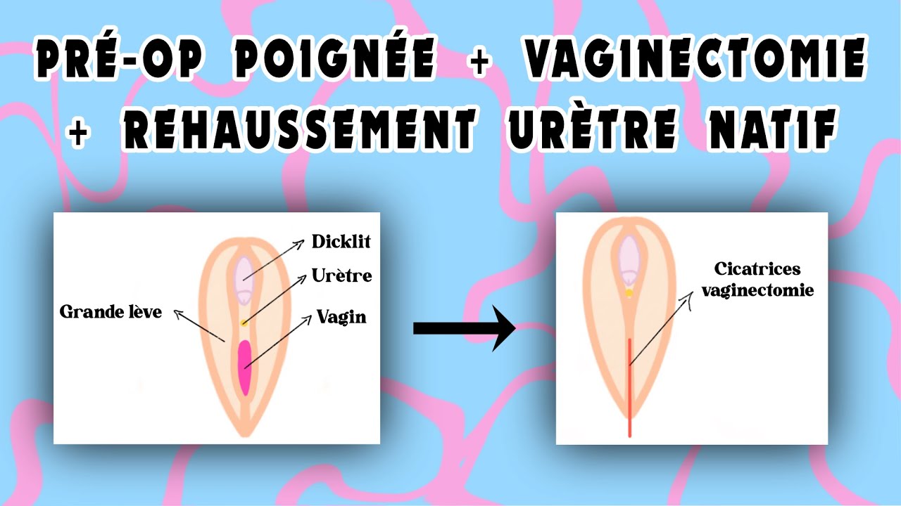 Pré-op 3 vaginectomie + rehaussement urètre + poignée // Ftm transgenre français // CRAZYDEN !