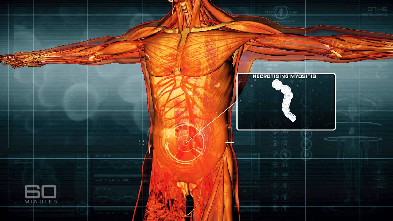 60 Minutes | Germ Warfare