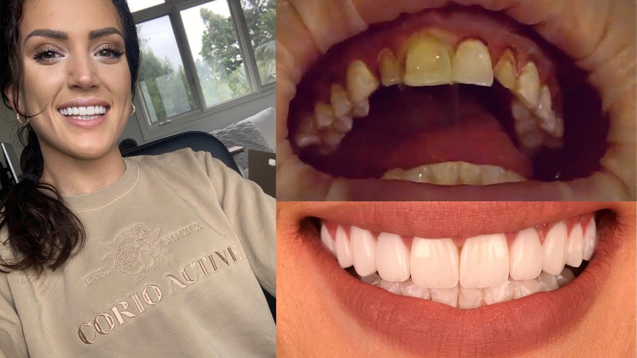 My Smile Transformation – Getting Composite Veneers!