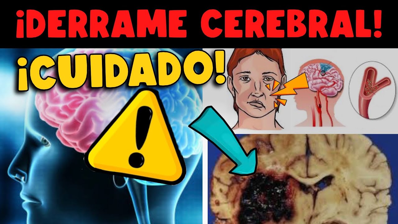 ¡CUIDADO! DERRAME CEREBRAL - SINTOMAS Y PREVENCIÓN
