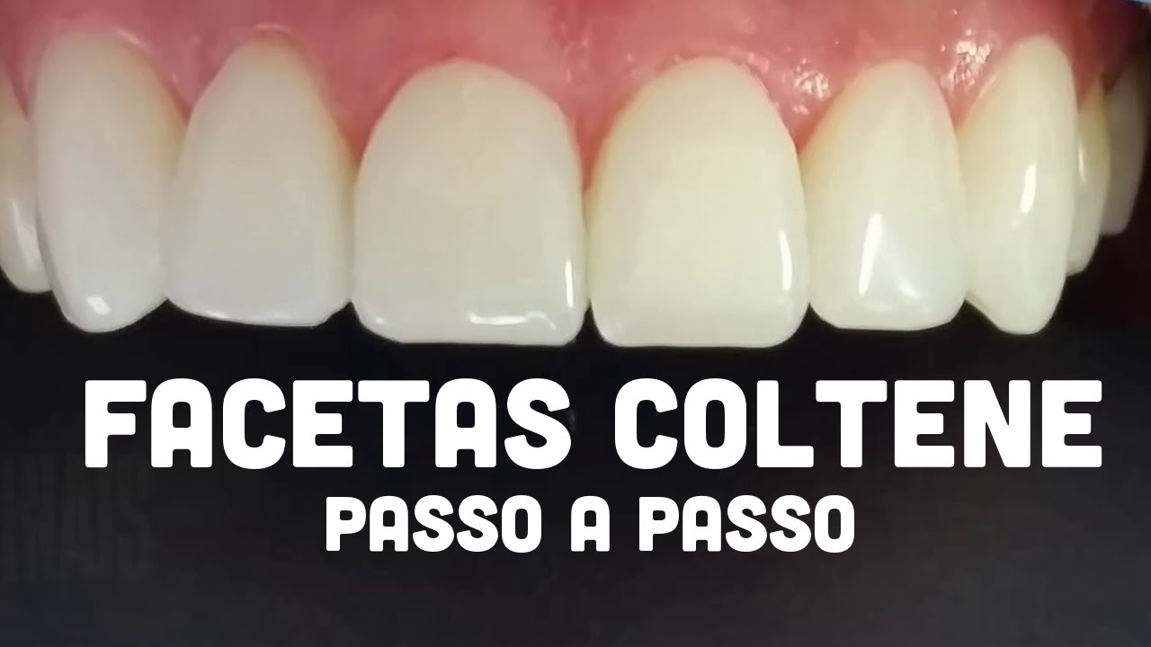 Facetas Coltene - Passo a Passo