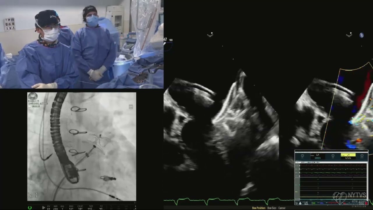 LIVE CASE 9 - Left Atrial Appendage Closure using Amplatzer Amulet