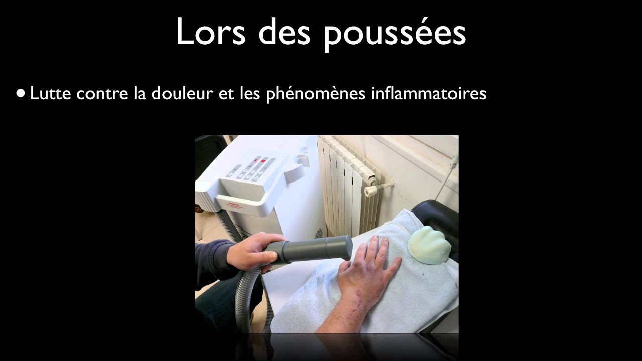Rééducation arthrose de la main
