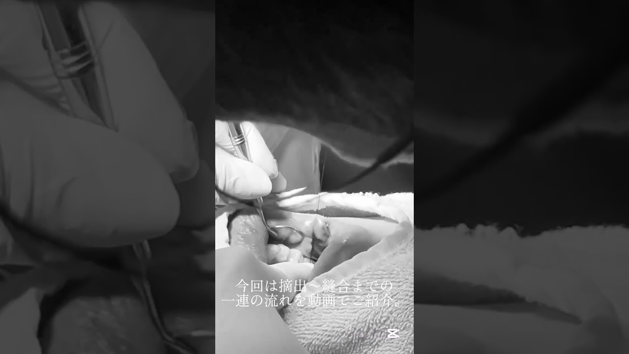 粘液嚢胞　摘出手術の様子 #dentist #歯医者 #粘液嚢胞