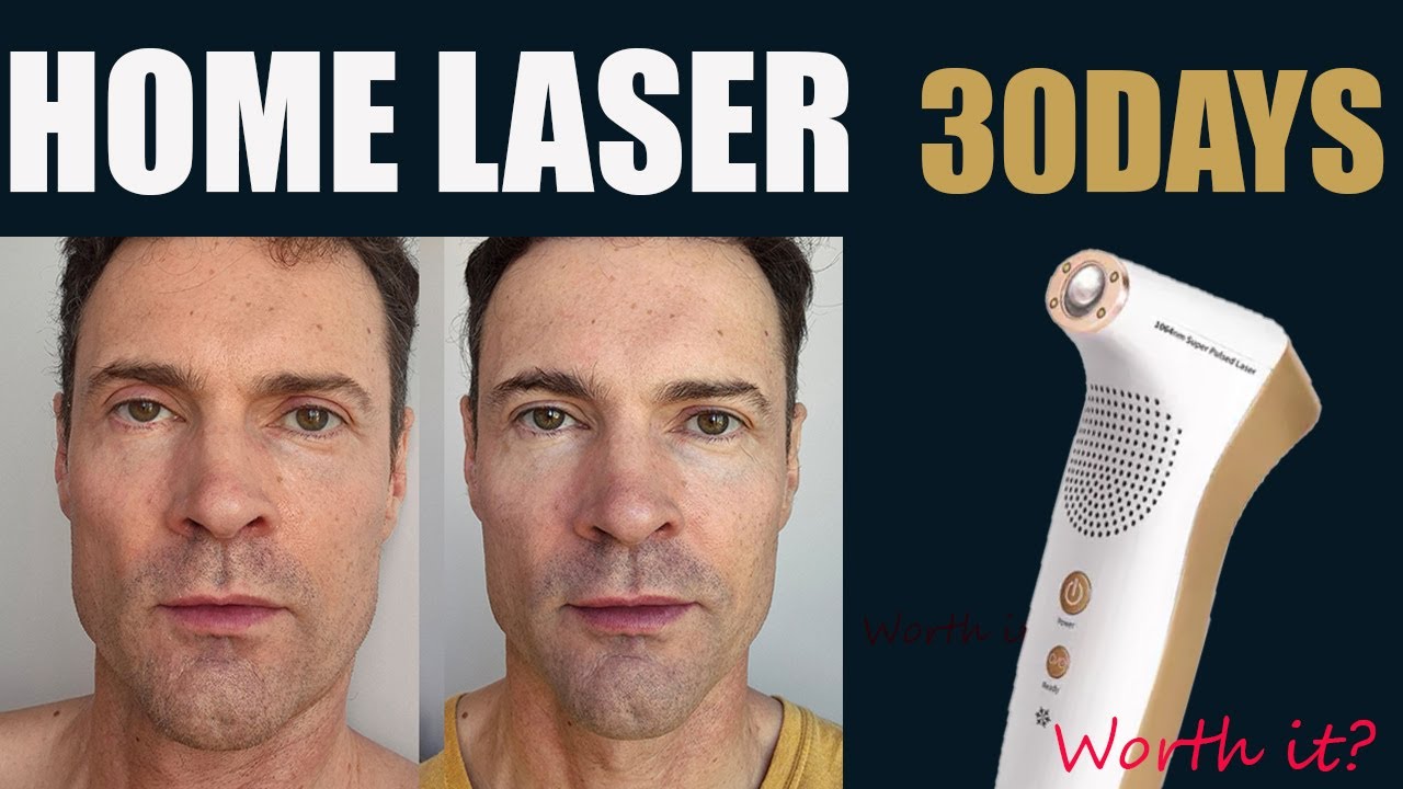 Я попробовала использовать клинический лазер дома, и вот что произошло!