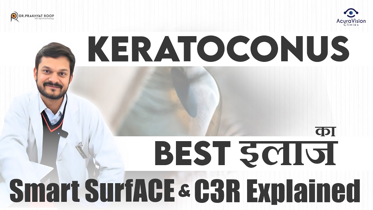 Keratoconus का Best इलाज: SmartSurfACE & C3R Explained | Dr. Prakhyat Roop