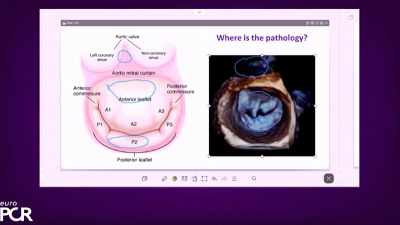 Treating diverse mitral regurgitation anatomies: the power of versatility - EuroPCR 2023