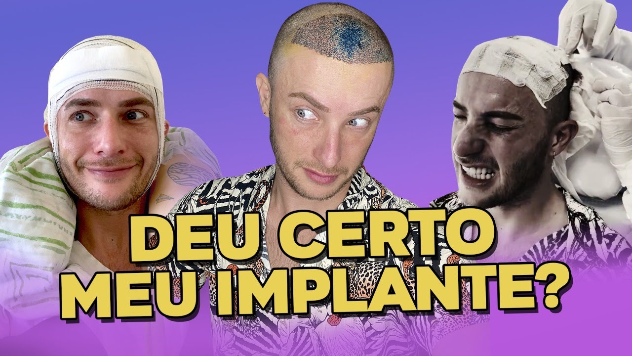 Um mês após o implante! Como ficou? - A FARSA DA BLOGAYRA CARECA Ep.4 #shorts | Maicon Santini