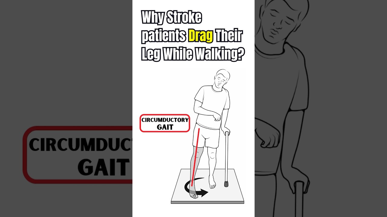 Why Stroke Patients Drag their Leg while walking?