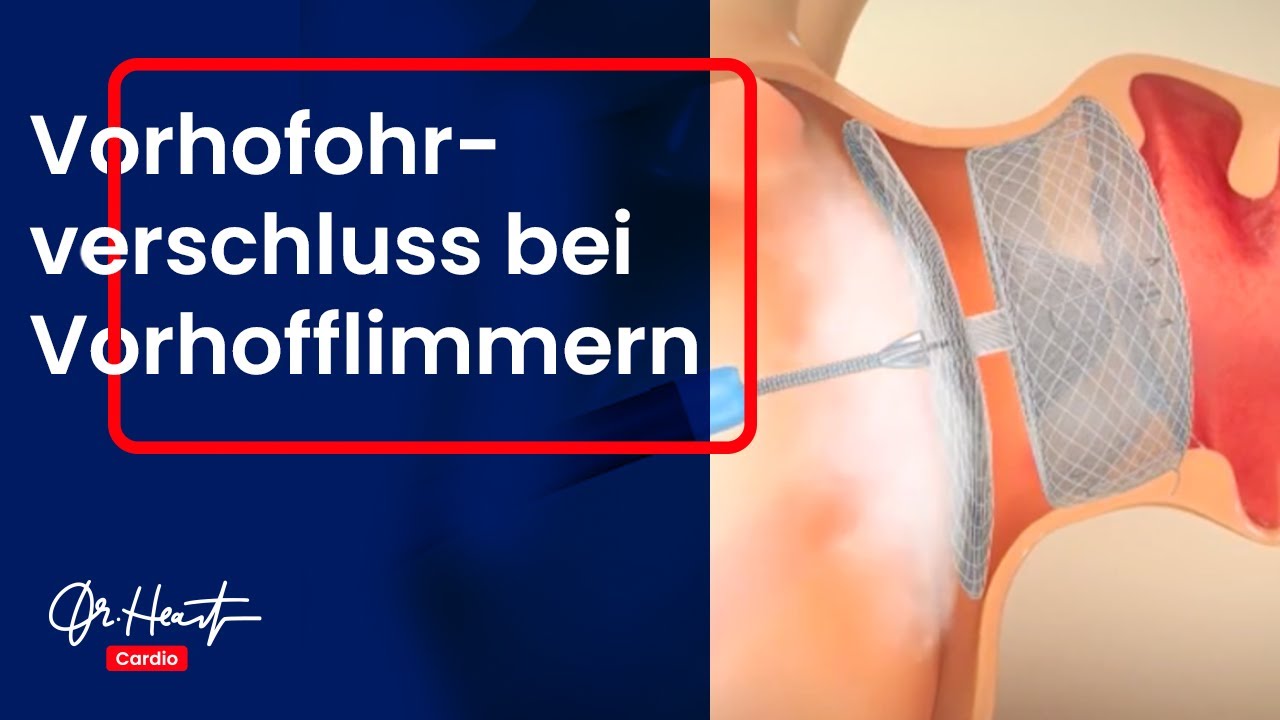 Schlaganfälle verhindern mit dem Vorhofohrverschluss | Dr. Heart