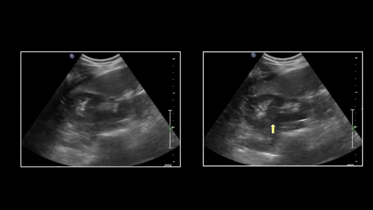 Ultrasound of the Abdomen & Pelvis | Free Radiology CME