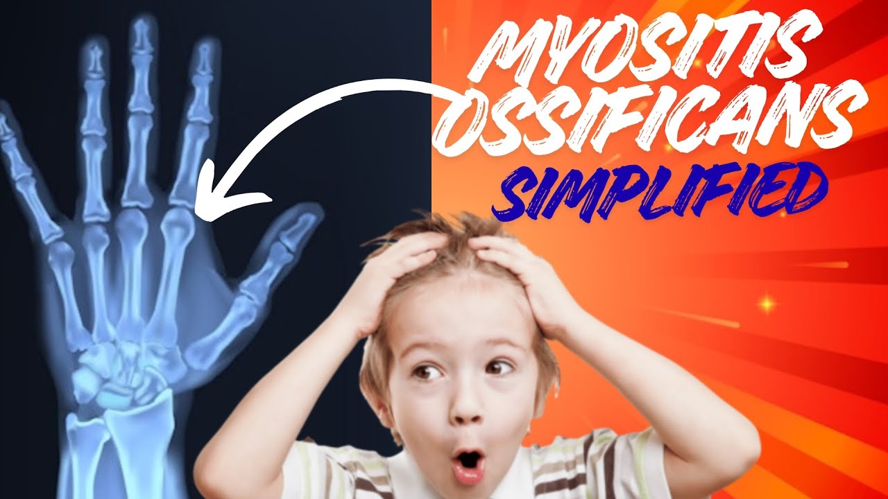 Myositis Ossificans Explained in 3 Minutes | X-Ray Findings , pathophysiology and Flowchart 