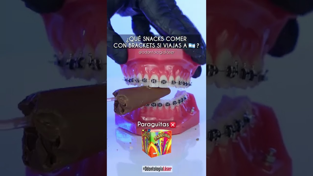 &iquest;Qu&eacute; alimentos comer con brackets si viajas a 🇦🇷? - Odontolog&iacute;a L&aacute;ser #Shorts