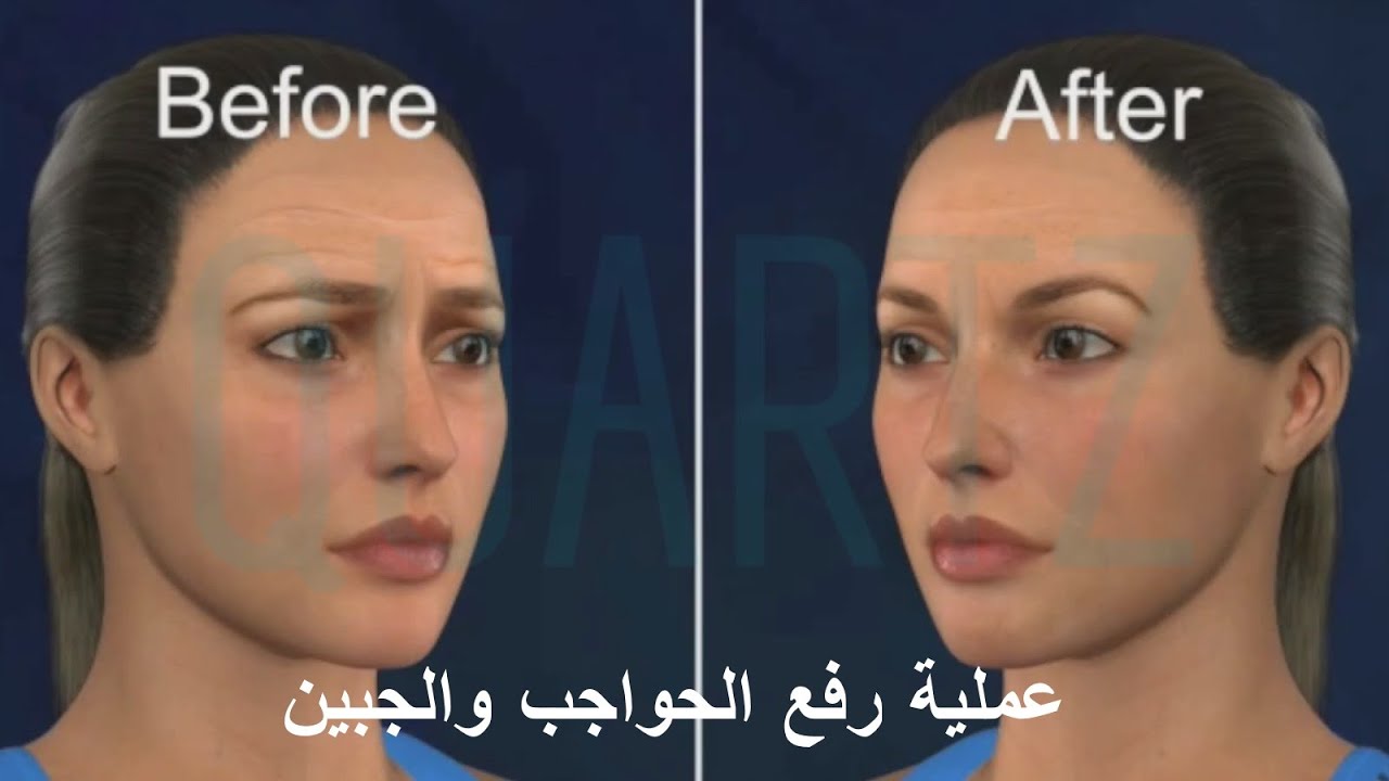 تجميل الجبين |هي الحل الانسب لحل مشاكل الحواجب| الجفون المرتخية | مع أشهر دكتورة تجميل | ليلى أرفاس