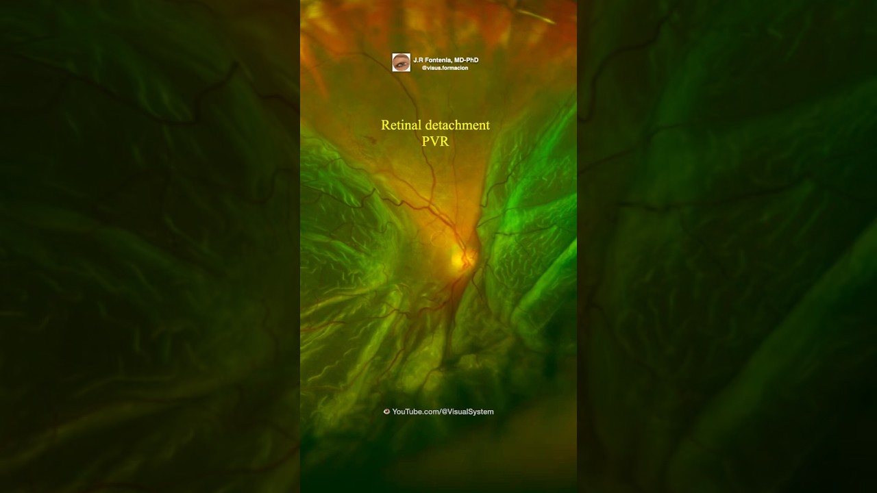 Retinal detachment. Proliferative vitreoretinopathy.