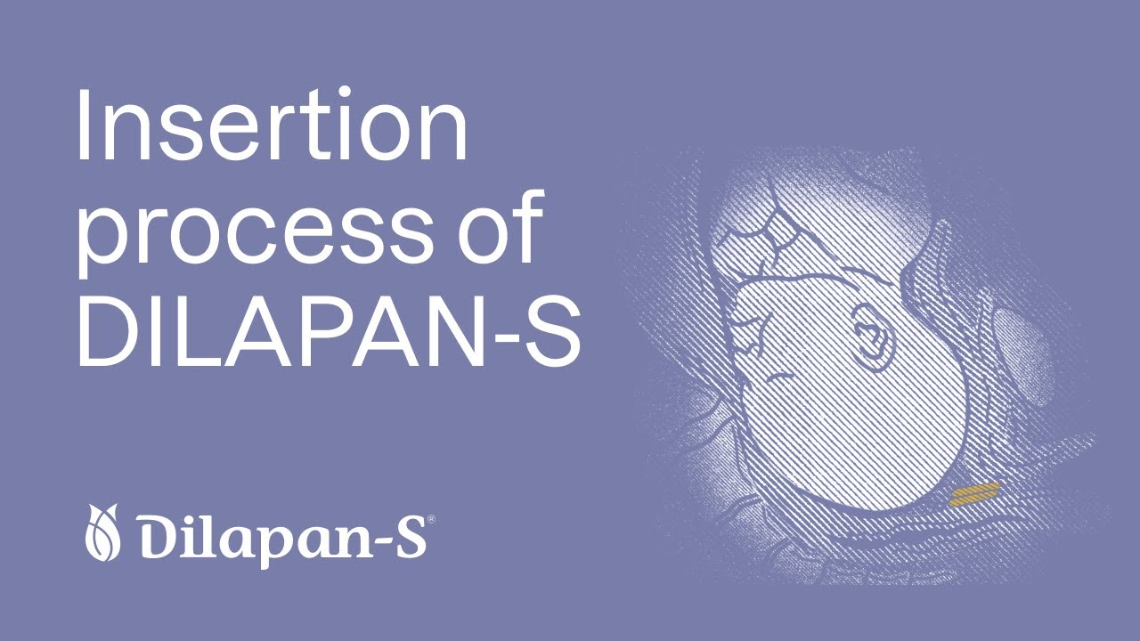 Insertion process of DILAPAN-S - step by step