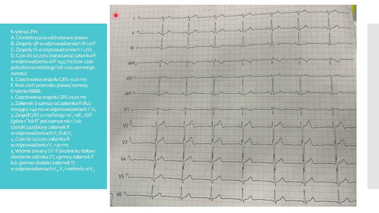 Część 3 - zaburzenia przewodnictwa - LPH, LAH, LBBB, RBBB