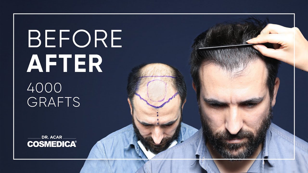 Hair Transplant in Turkey | Results | Dr. Acar | Cosmedica Clinic