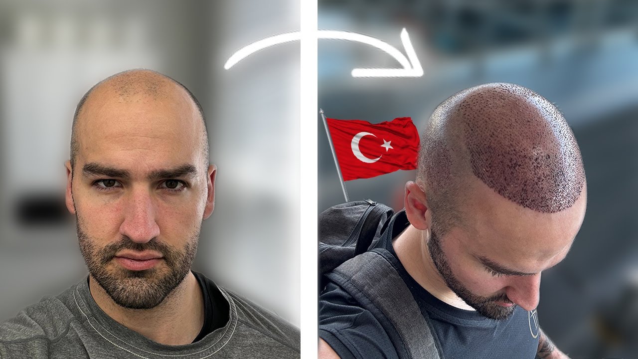 I Got A Hair Transplant in Turkey | Now Hair Time Clinic