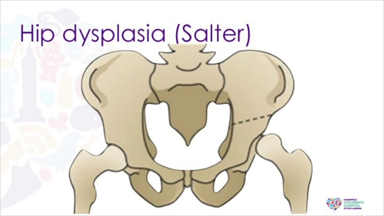 Pediatric Hip - ABOS Orthopedic Surgery Board Exam Review