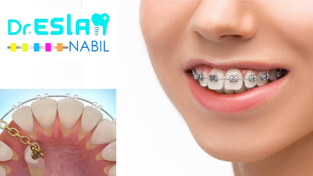 ما هي مده نزول ناب منطمر في الفك العلوي؟ دكتور اسلام نبيل يجاوب تقويم الأسنان بدون خلع
