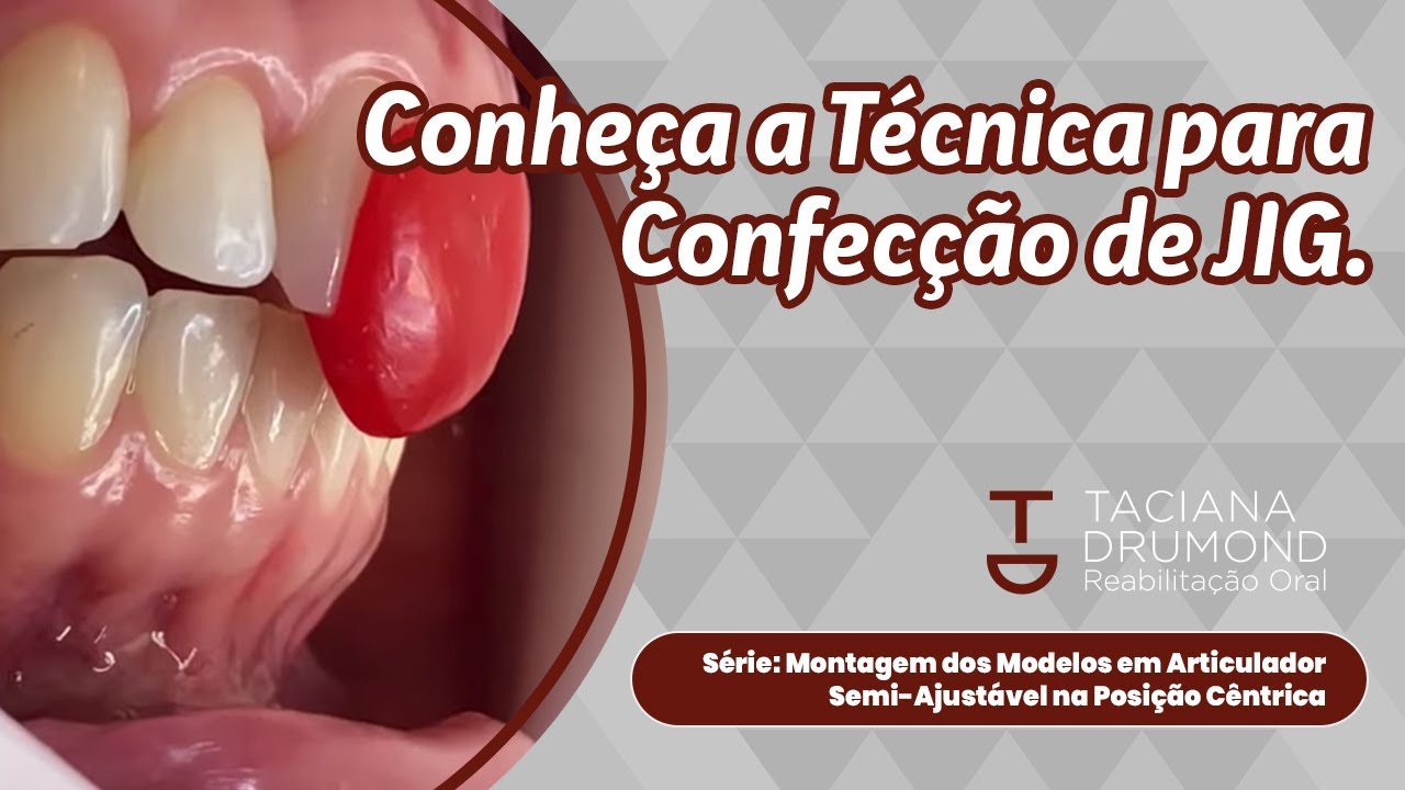 Técnica para Confecção do Jig para Obtenção da Relação Cêntrica com Resina Acrílica
