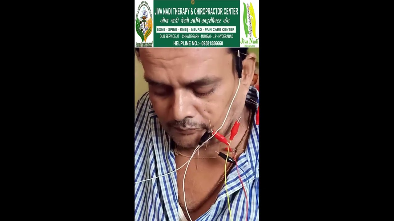 Bell's palsy acupuncture treatment by Mumbai best Chiropractor Dr saurabh at Jiva Nadi - Mulund 