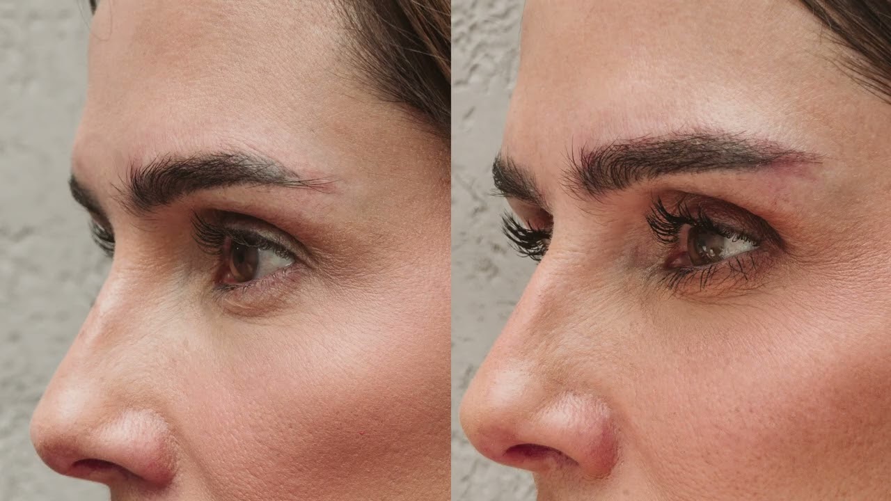 Transplante de Sobrancelhas da Deborah Secco