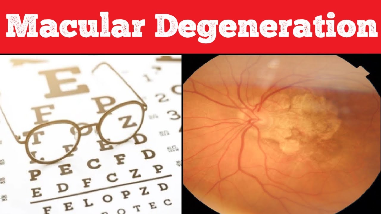 Age-Related Macular Degeneration (AMD) | Signs, Symptoms, Diagnosis, Treatment