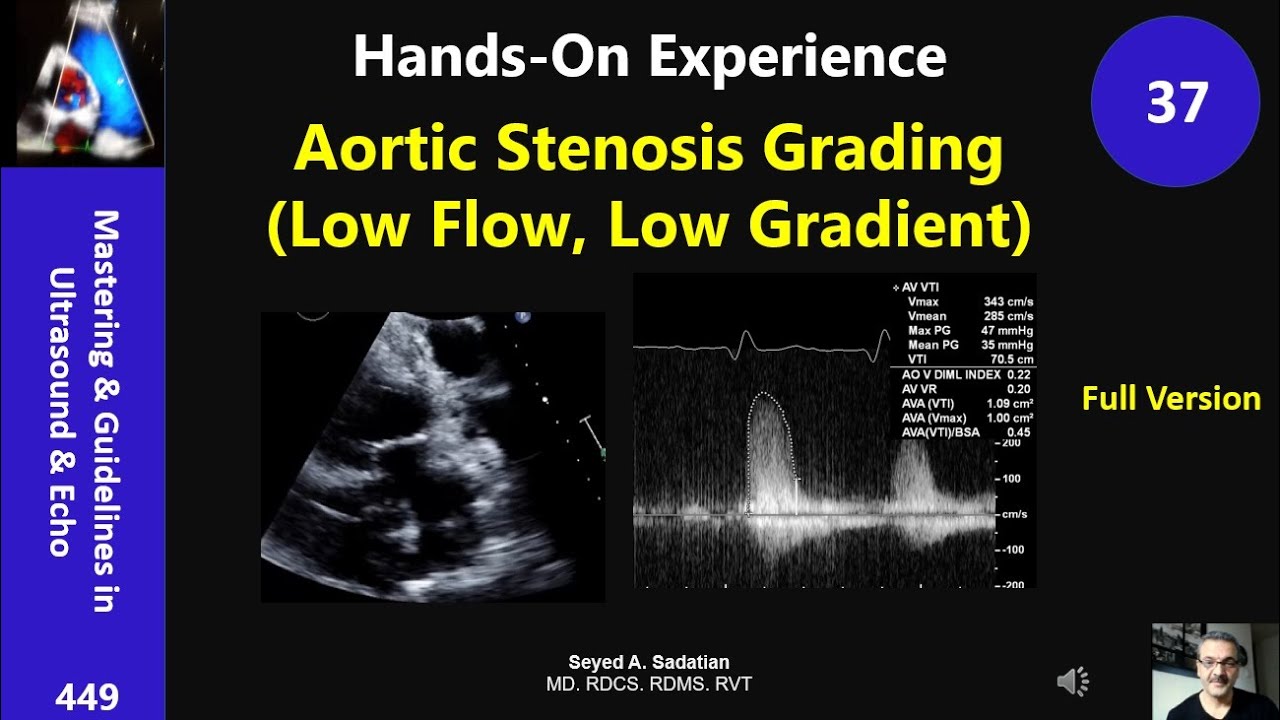 Hands-On Experience 37: Aortic Stenosis Grading (Low Flow, Low Gradient)