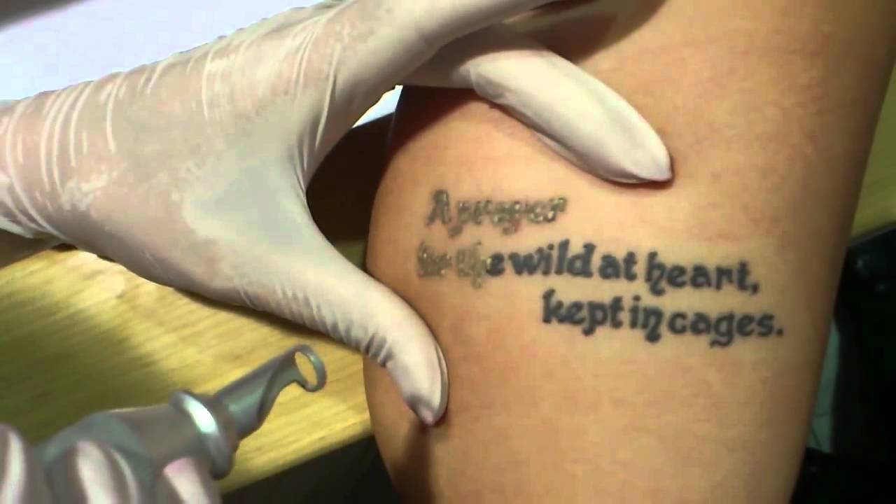 Skidanje Tetovaže