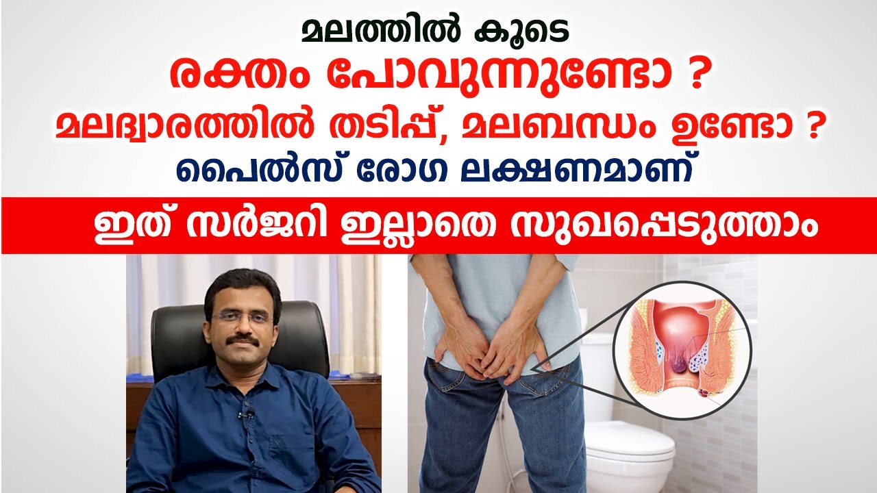 പൈൽസ് സർജറി കൂടാതെ 1 ദിവസം കൊണ്ട് നീക്കം ചെയ്യാം | Piles Treatment Without Surgery | Arogyam
